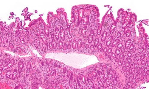 Celiac_disease_-_intermed_mag