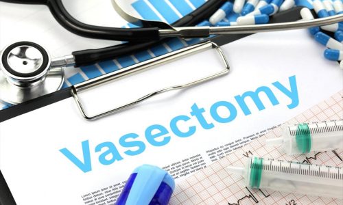 vasectomy